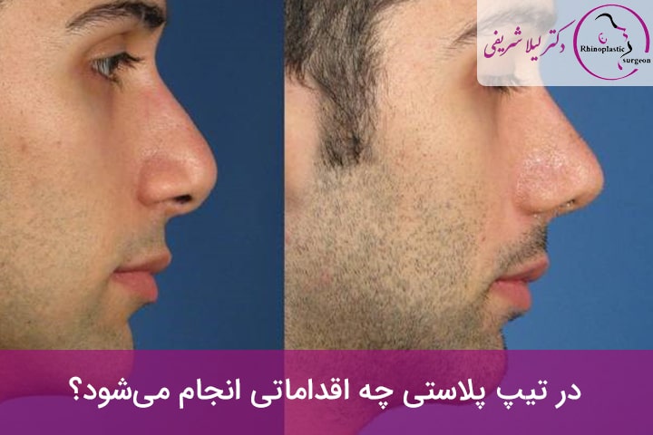 نتیجه تیپ پلاستی بینی