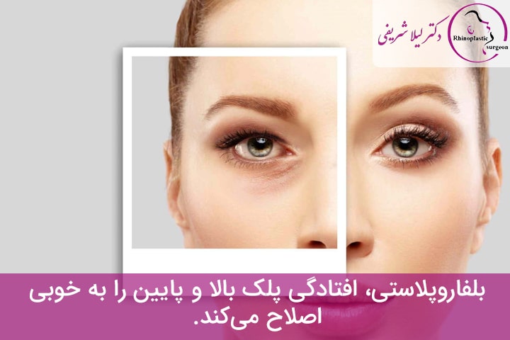 عمل بلفاروپلاستی