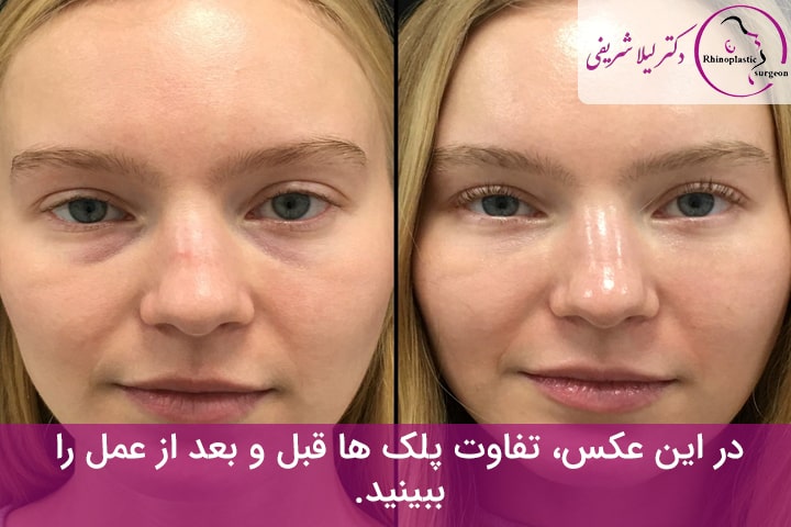 عمل افتادگی پلک