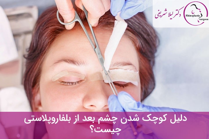 کوچک شدن چشم بعد از بلفاروپلاستی