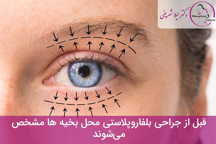 مشخص‌کردن محدوده عمل بلفاروپلاستی