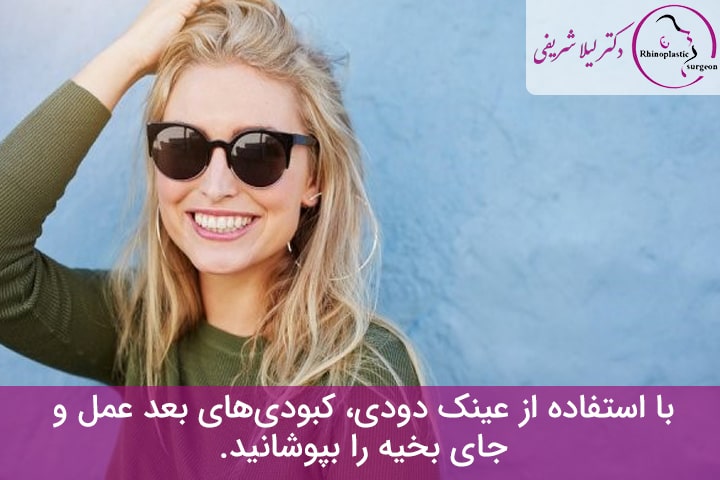 کبودی بعد از بلفاروپلاستی