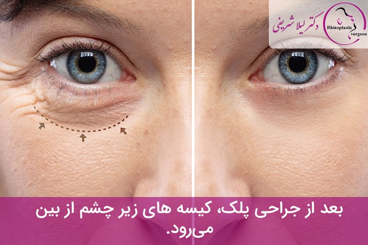 بلفاروپلاستی پلک پایین