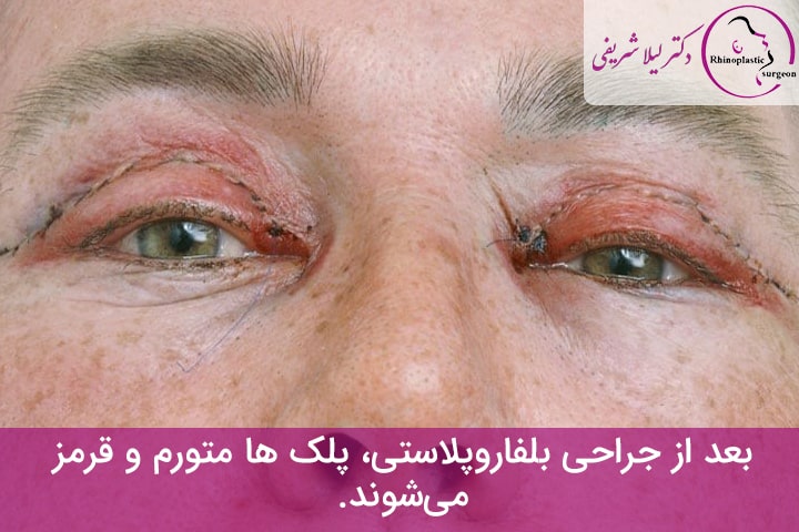 ورم پلک بعد از عمل بلفاروپلاستی