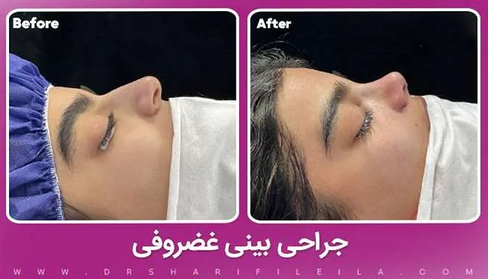 قبل و بعد عمل بینی غضروفی دکتر لیلا شریفی