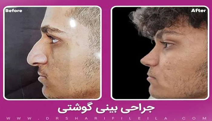 قبل و بعد عمل بینی گوشتی دکتر لیلا شریفی