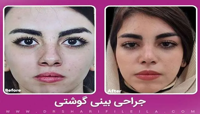قبل و بعد عمل بینی گوشتی دکتر لیلا شریفی