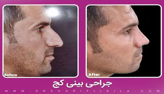 قبل و بعد عمل بینی کج دکتر لیلا شریفی