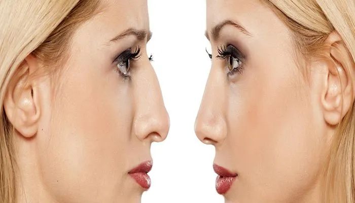 قبل و بعد عمل بینی نیمه فانتزی