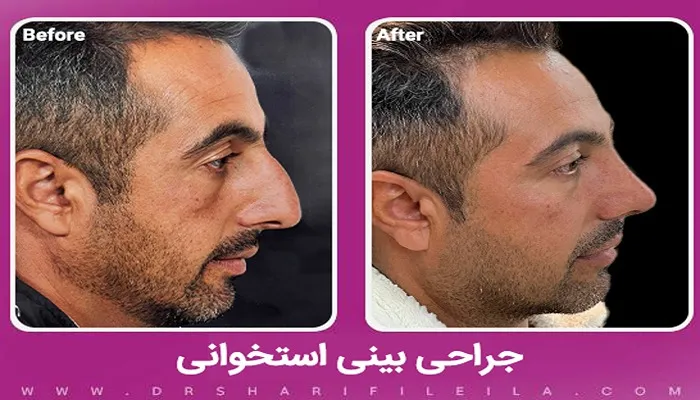 قبل و بعد جراحی بینی استخوانی دکتر لیلا شریفی