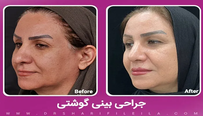 قبل و بعد جراحی بینی گوشتی دکتر لیلا شریفی
