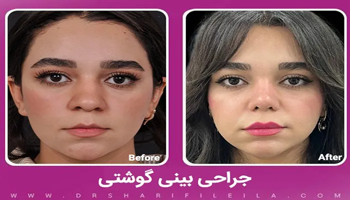 قبل و بعد جراحی بینی گوشتی دکتر لیلا شریفی