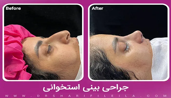 جراحی بینی استخوانی