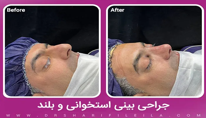 جراحی بینی استخوانی بلند