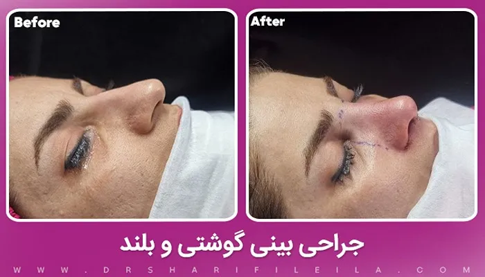 جراحی بینی گوشتی و بلند