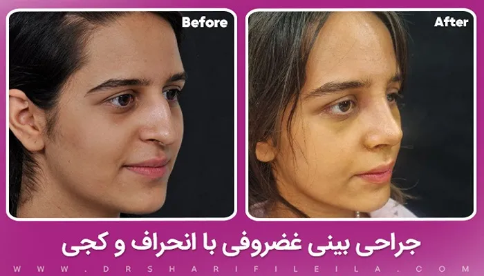 جراحی بینی غضروفی با انحراف و کجی