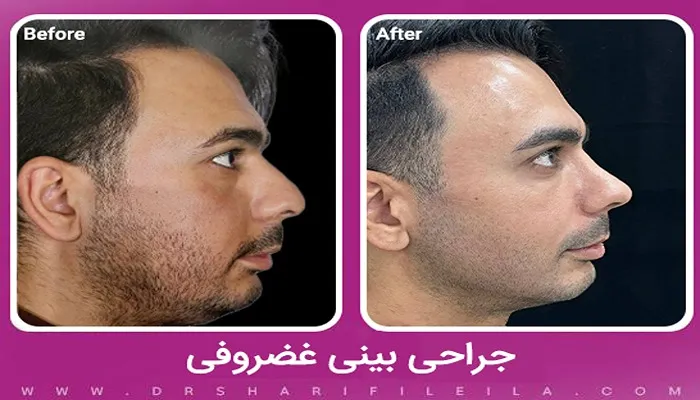 جراحی بینی غضروفی