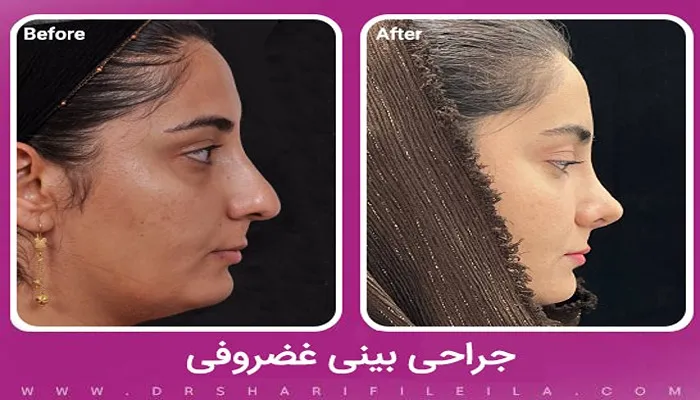 جراحی بینی غضروفی
