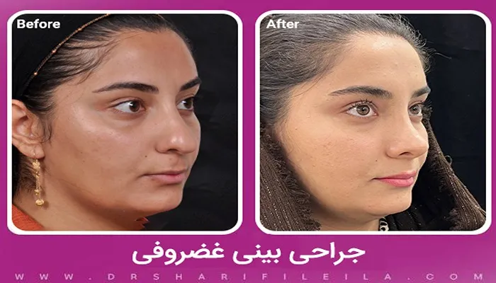 جراحی بینی غضروفی
