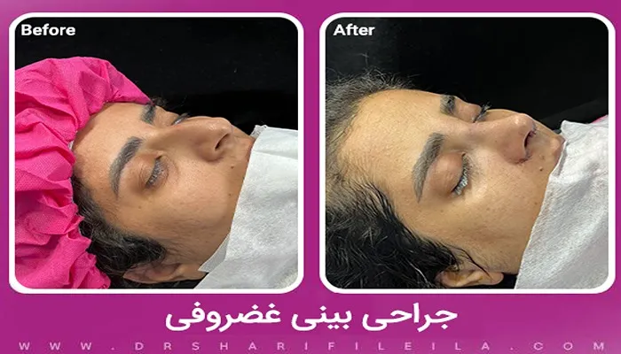 جراحی بینی غضروفی