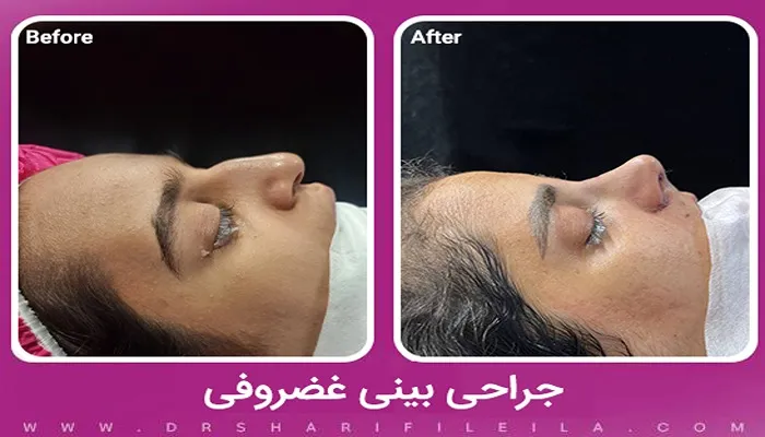 جراحی بینی غضروفی