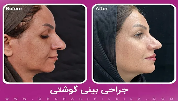 جراحی بینی گوشتی